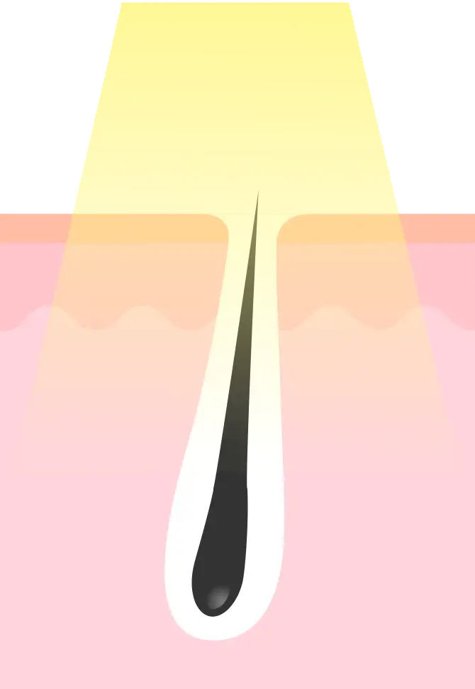 最新機器で毛根にしっかり照射