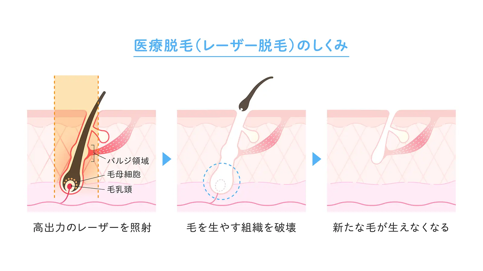 レーザー脱毛の特徴