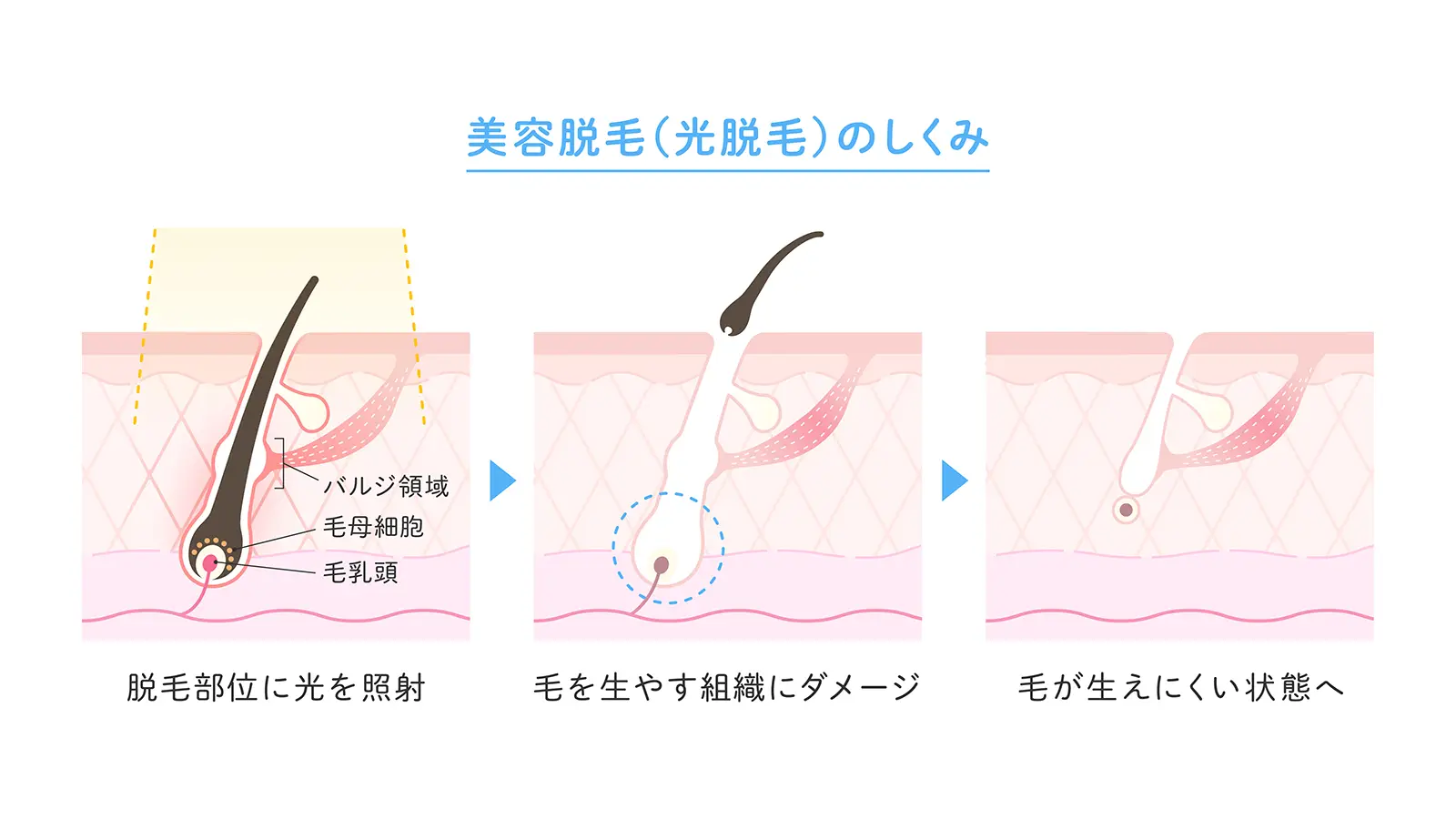 光脱毛（IPL脱毛）の特徴